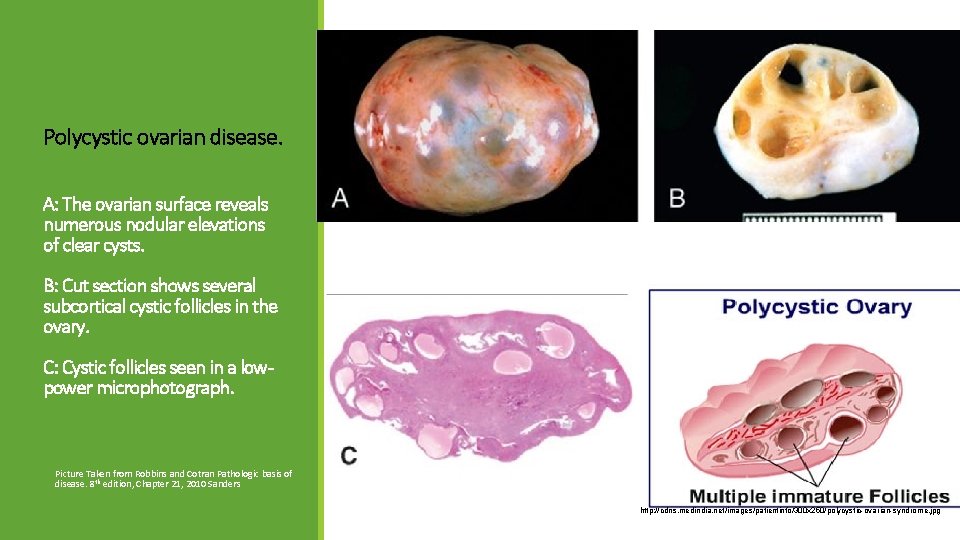 Polycystic ovarian disease. A: The ovarian surface reveals numerous nodular elevations of clear cysts.