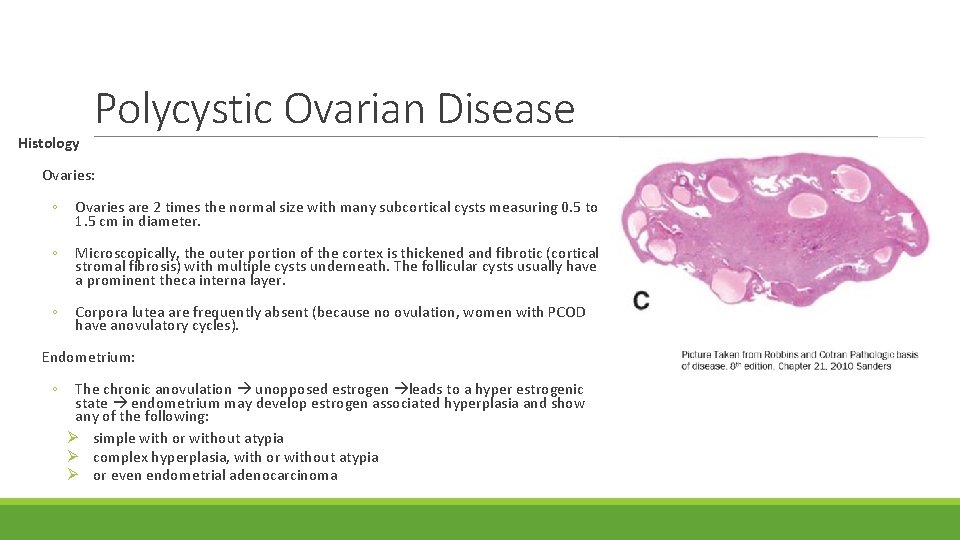 Histology Polycystic Ovarian Disease Ovaries: ◦ Ovaries are 2 times the normal size with