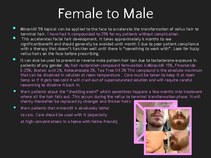 Female to Male § § § Minoxidil 5% topical can be applied to the