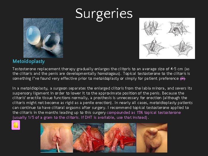Surgeries Metoidoplasty Testosterone replacement therapy gradually enlarges the clitoris to an average size of