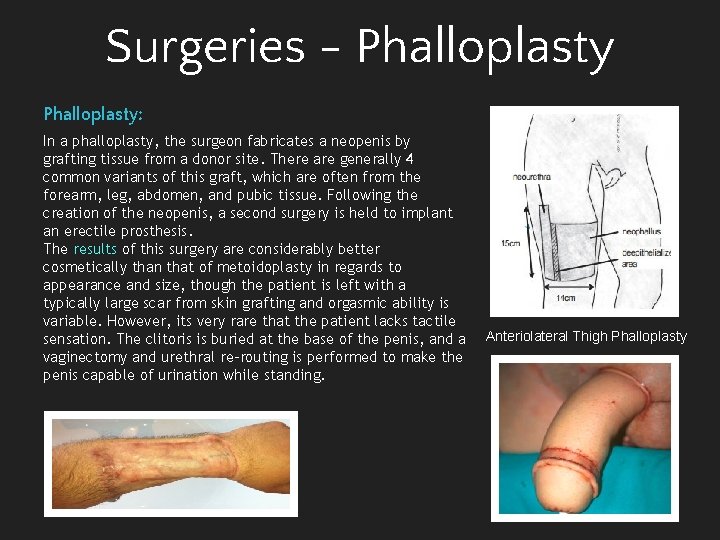 Surgeries - Phalloplasty: In a phalloplasty, the surgeon fabricates a neopenis by grafting tissue