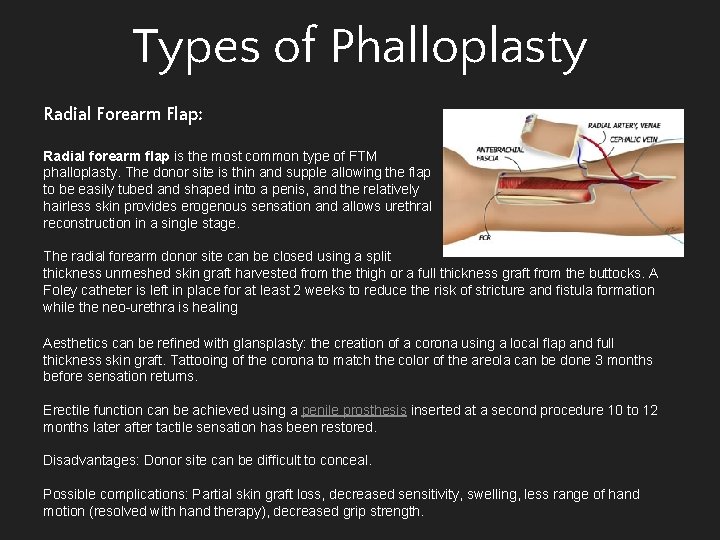 Types of Phalloplasty Radial Forearm Flap: Radial forearm flap is the most common type