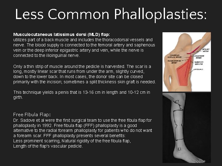 Less Common Phalloplasties: Musculocutaneous latissimus dorsi (MLD) flap: utilizes part of a back muscle