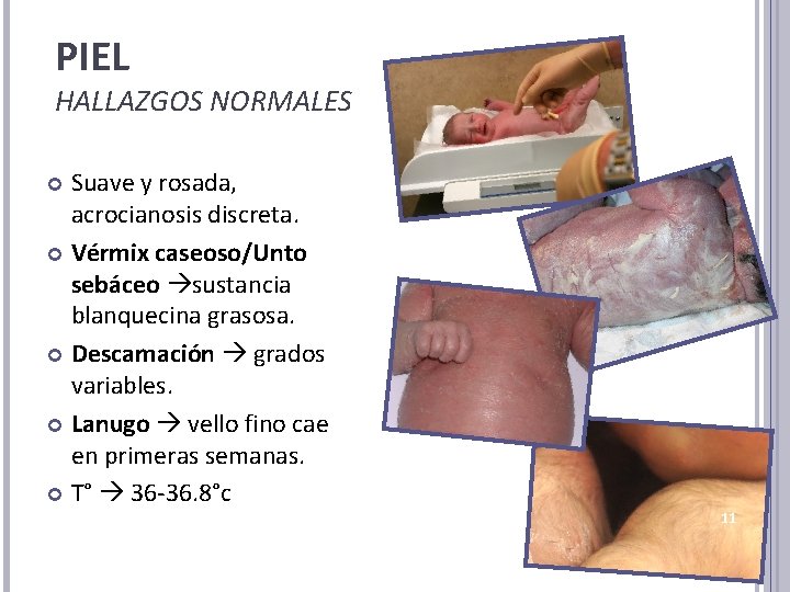 PIEL HALLAZGOS NORMALES Suave y rosada, acrocianosis discreta. Vérmix caseoso/Unto sebáceo sustancia blanquecina grasosa.