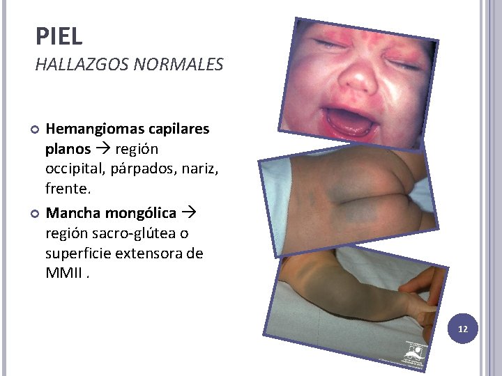 PIEL HALLAZGOS NORMALES Hemangiomas capilares planos región occipital, párpados, nariz, frente. Mancha mongólica región