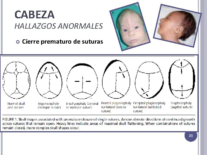 CABEZA HALLAZGOS ANORMALES Cierre prematuro de suturas 21 