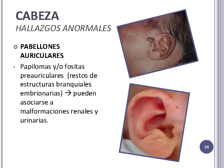 CABEZA HALLAZGOS ANORMALES • PABELLONES AURICULARES Papilomas y/o fositas preauriculares (restos de estructuras branquiales