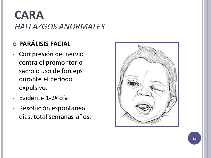 CARA HALLAZGOS ANORMALES • • • PARÁLISIS FACIAL Compresión del nervio contra el promontorio