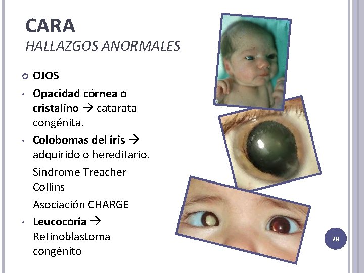 CARA HALLAZGOS ANORMALES • • • OJOS Opacidad córnea o cristalino catarata congénita. Colobomas