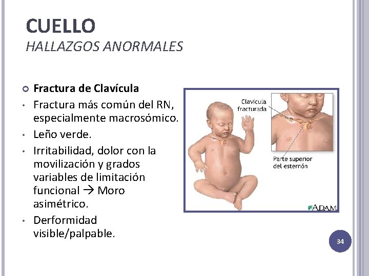 CUELLO HALLAZGOS ANORMALES • • Fractura de Clavícula Fractura más común del RN, especialmente