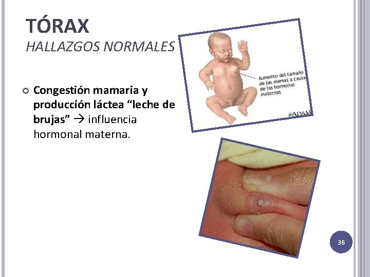 TÓRAX HALLAZGOS NORMALES Congestión mamaria y producción láctea “leche de brujas” influencia hormonal materna.