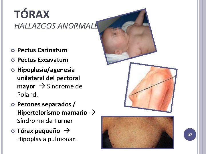 TÓRAX HALLAZGOS ANORMALES Pectus Carinatum Pectus Excavatum Hipoplasia/agenesia unilateral del pectoral mayor Síndrome de