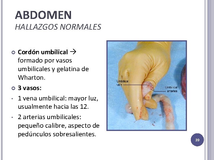 ABDOMEN HALLAZGOS NORMALES Cordón umbilical formado por vasos umbilicales y gelatina de Wharton. 3 ABDOMEN HALLAZGOS NORMALES Cordón umbilical formado por vasos umbilicales y gelatina de Wharton. 3