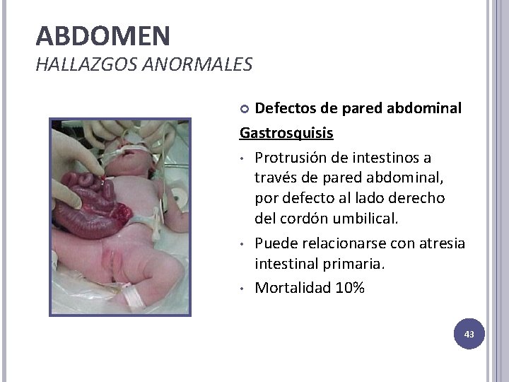 ABDOMEN HALLAZGOS ANORMALES Defectos de pared abdominal Gastrosquisis • Protrusión de intestinos a través