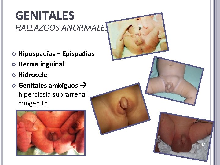 GENITALES HALLAZGOS ANORMALES Hipospadias – Epispadias Hernia inguinal Hidrocele Genitales ambiguos hiperplasia suprarrenal congénita.