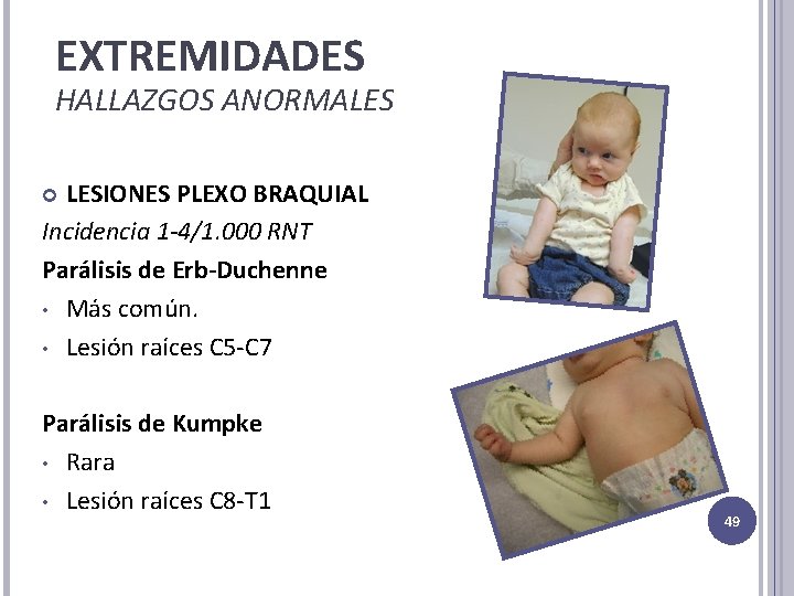 EXTREMIDADES HALLAZGOS ANORMALES LESIONES PLEXO BRAQUIAL Incidencia 1 -4/1. 000 RNT Parálisis de Erb-Duchenne EXTREMIDADES HALLAZGOS ANORMALES LESIONES PLEXO BRAQUIAL Incidencia 1 -4/1. 000 RNT Parálisis de Erb-Duchenne