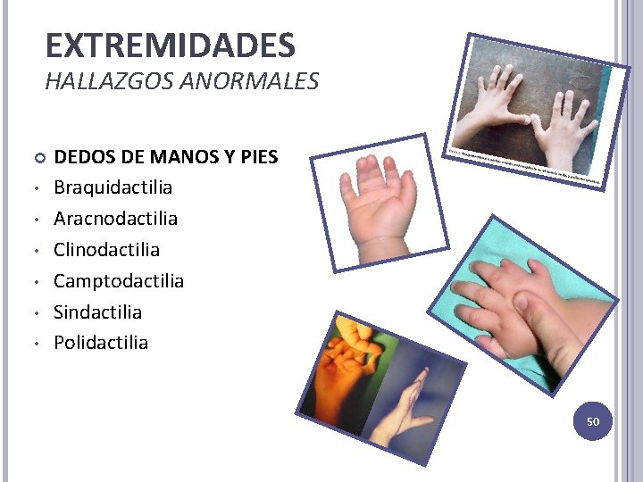 EXTREMIDADES HALLAZGOS ANORMALES • • • DEDOS DE MANOS Y PIES Braquidactilia Aracnodactilia Clinodactilia