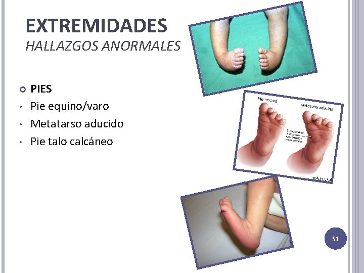 EXTREMIDADES HALLAZGOS ANORMALES • • • PIES Pie equino/varo Metatarso aducido Pie talo calcáneo EXTREMIDADES HALLAZGOS ANORMALES • • • PIES Pie equino/varo Metatarso aducido Pie talo calcáneo