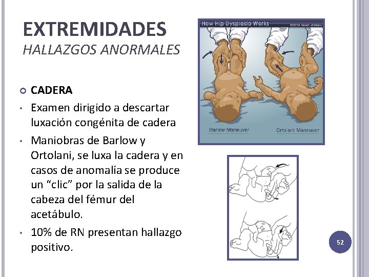 EXTREMIDADES HALLAZGOS ANORMALES • • • CADERA Examen dirigido a descartar luxación congénita de