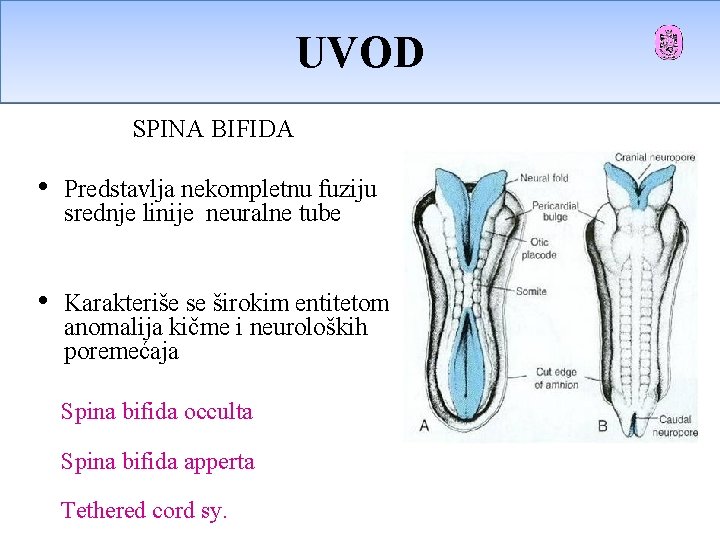 UVOD Uvod SPINA BIFIDA • Predstavlja nekompletnu fuziju srednje linije neuralne tube • Karakteriše UVOD Uvod SPINA BIFIDA • Predstavlja nekompletnu fuziju srednje linije neuralne tube • Karakteriše