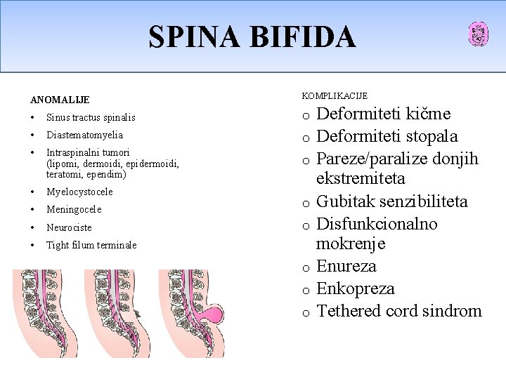 SPINA BIFIDA OCCULTA SPINA BIFIDA Spina Bifida Oculta ANOMALIJE KOMPLIKACIJE • Sinus tractus spinalis SPINA BIFIDA OCCULTA SPINA BIFIDA Spina Bifida Oculta ANOMALIJE KOMPLIKACIJE • Sinus tractus spinalis