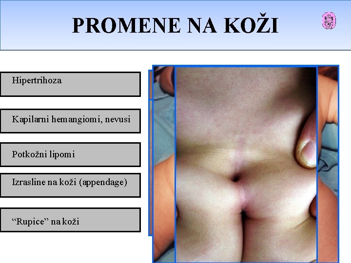 PROMENENA NAKOŽI PROMENE Hipertrihoza Kapilarni hemangiomi, nevusi Potkožni lipomi Izrasline na koži (appendage) “Rupice” PROMENENA NAKOŽI PROMENE Hipertrihoza Kapilarni hemangiomi, nevusi Potkožni lipomi Izrasline na koži (appendage) “Rupice”