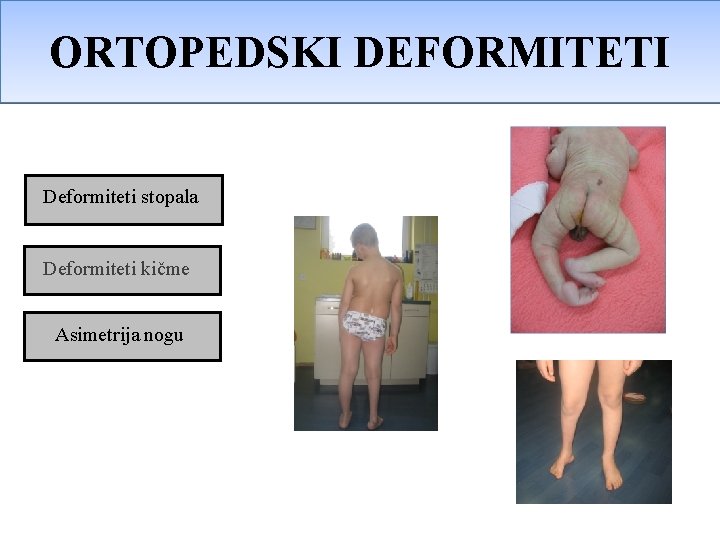 ORTOPEDSKE PROMENE ORTOPEDSKI DEFORMITETI Deformiteti stopala Deformiteti kičme Asimetrija nogu ORTOPEDSKE PROMENE ORTOPEDSKI DEFORMITETI Deformiteti stopala Deformiteti kičme Asimetrija nogu