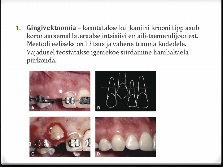 1. Gingivektoomia – kasutatakse kui kaniini krooni tipp asub koronaarsemal lateraalse intsisiivi emaili-tsemendijoonest. Meetodi