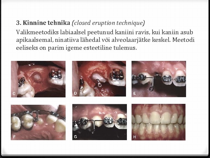 3. Kinnine tehnika (closed eruption technique) Valikmeetodiks labiaalsel peetunud kaniini ravis, kui kaniin asub