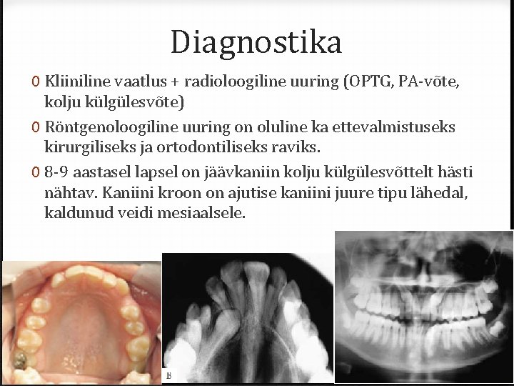 Diagnostika 0 Kliiniline vaatlus + radioloogiline uuring (OPTG, PA-võte, kolju külgülesvõte) 0 Röntgenoloogiline uuring