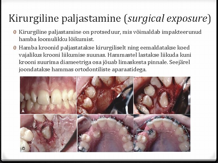 Kirurgiline paljastamine (surgical exposure) 0 Kirurgiline paljastamine on protseduur, mis võimaldab impakteerunud hamba loomulikku