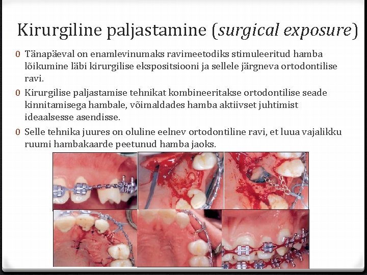 Kirurgiline paljastamine (surgical exposure) 0 Tänapäeval on enamlevinumaks ravimeetodiks stimuleeritud hamba lõikumine läbi kirurgilise