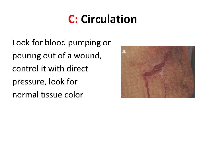 C: Circulation Look for blood pumping or pouring out of a wound, control it