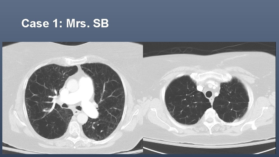 Case 1: Mrs. SB 