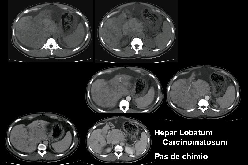 Hepar Lobatum Carcinomatosum Pas de chimio 