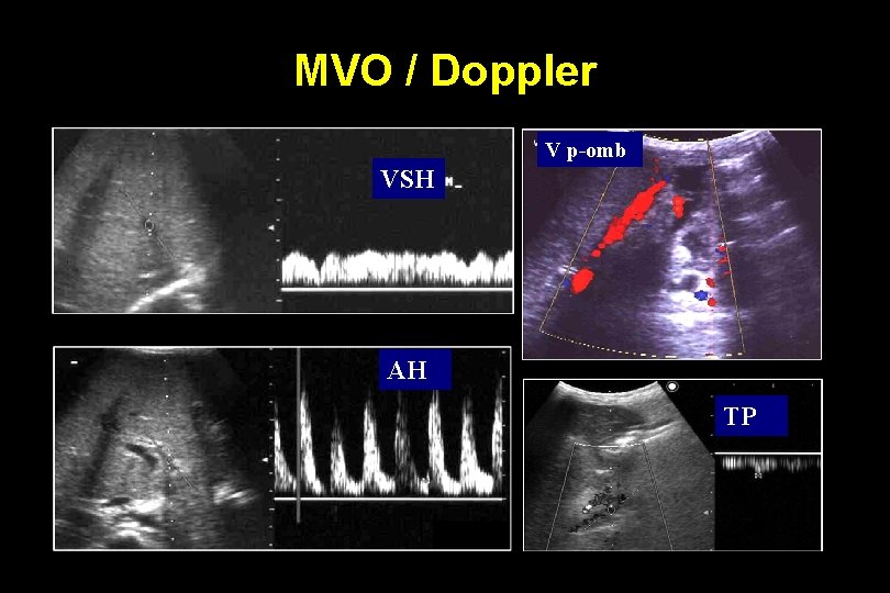 MVO / Doppler V p-omb VSH AH TP 