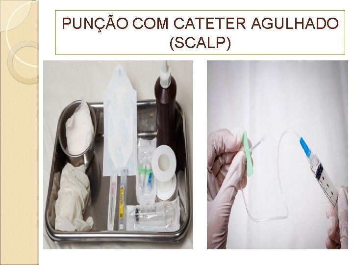 PUNÇÃO COM CATETER AGULHADO (SCALP) 