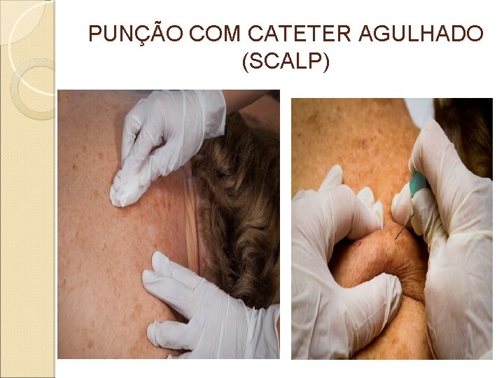 PUNÇÃO COM CATETER AGULHADO (SCALP) 