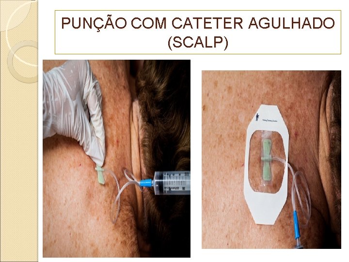 PUNÇÃO COM CATETER AGULHADO (SCALP) 