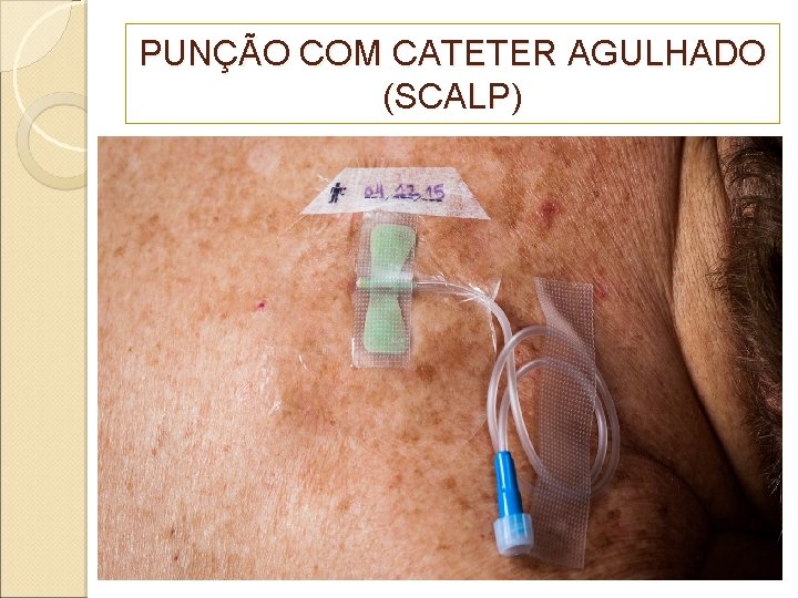 PUNÇÃO COM CATETER AGULHADO (SCALP) 