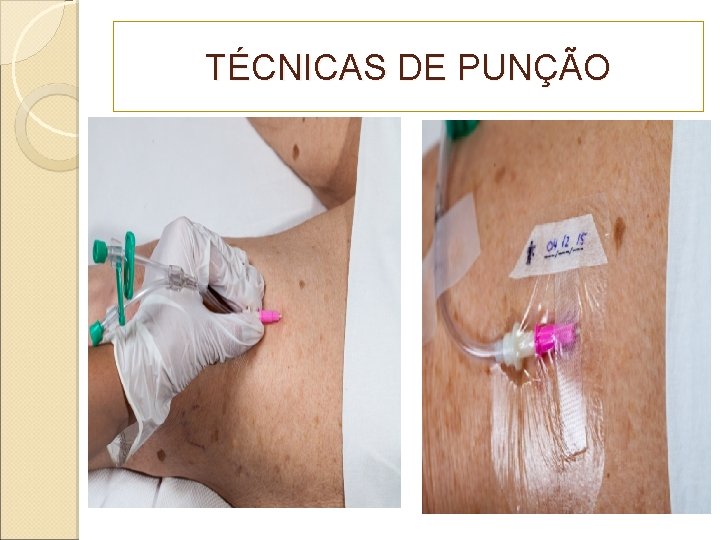 TÉCNICAS DE PUNÇÃO 