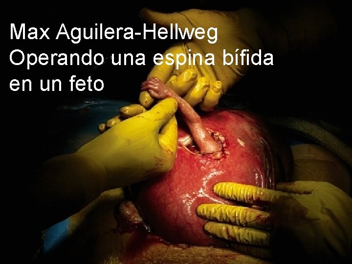 Max Aguilera-Hellweg Operando una espina bífida en un feto 