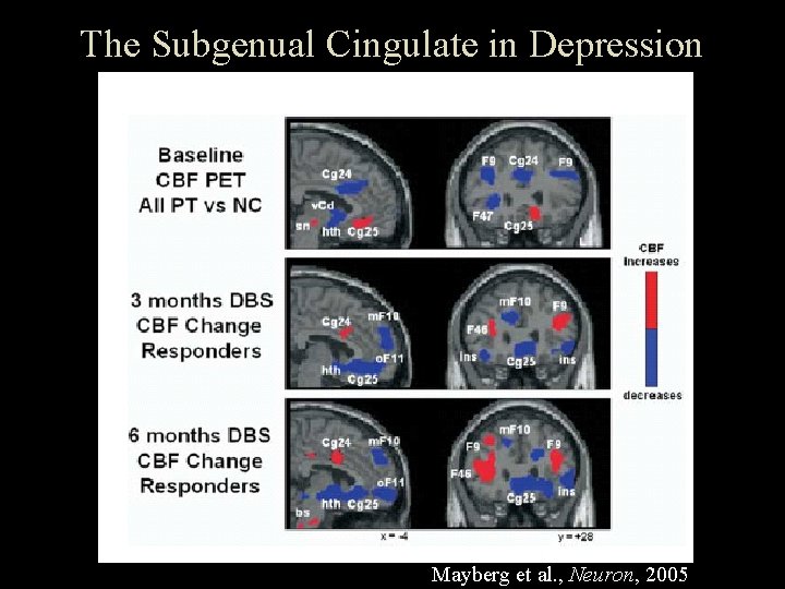 The Subgenual Cingulate in Depression Mayberg et al. , Neuron, 2005 