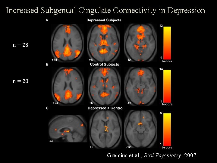 Increased Subgenual Cingulate Connectivity in Depression n = 28 n = 20 Greicius et