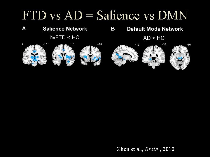 FTD vs AD = Salience vs DMN Zhou et al. , Brain , 2010