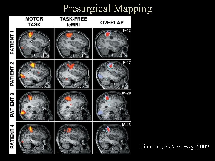 Presurgical Mapping Liu et al. , J Neurosurg, 2009 