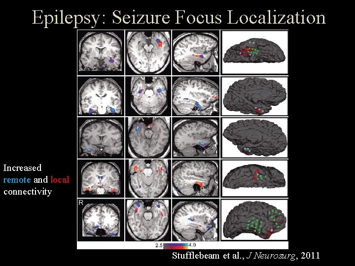 Epilepsy: Seizure Focus Localization Increased remote and local connectivity Stufflebeam et al. , J