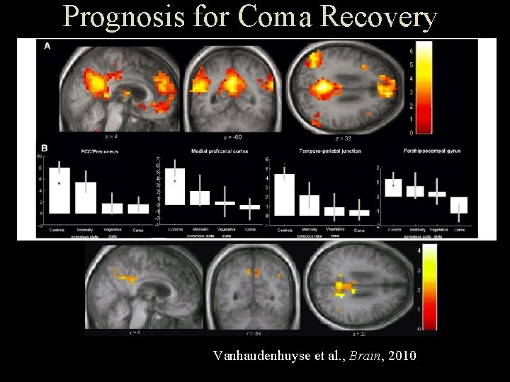 Prognosis for Coma Recovery Vanhaudenhuyse et al. , Brain, 2010 