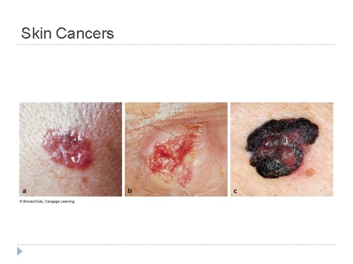 Skin Cancers 