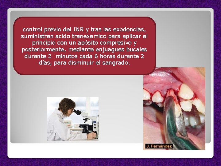 control previo del INR y tras las exodoncias, suministran acido tranexamico para aplicar al
